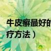 牛皮癣最好的治疗方法中医（牛皮癣最好的治疗方法）