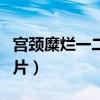 宫颈糜烂一二三度图片（宫颈糜烂的症状及图片）