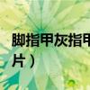 脚指甲灰指甲症状图片（脚趾甲灰指甲初期图片）