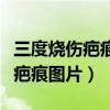 三度烧伤疤痕图片激光效果怎么样（三度烧伤疤痕图片）