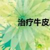 治疗牛皮屑的土方法（牛皮屑偏方）