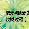 拔牙4颗牙齿收缝需要多久（拔了4颗牙牙缝收拢过程）