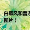 白癜风和普通白斑的区别（白癜风与白斑区别图片）