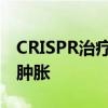 CRISPR治疗可减缓遗传性血管性水肿患者的肿胀